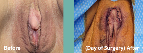 Surgical Correction of Large Clitoral Hood