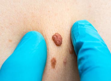 Anal Skin Tags