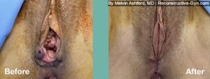 Vaginoplasty