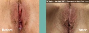 Vaginoplasty