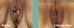 Labiaplasty and Vaginoplasty