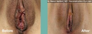 Labiaplasty, Vaginoplasty, and Clitoroplasty