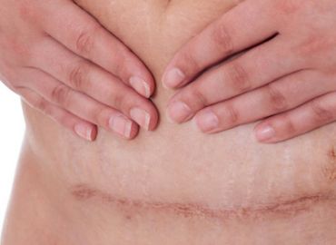 Post Cesarean Scar "Apron"