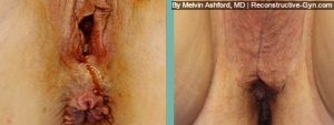 Vaginoplasty
