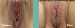 Labiaplasty, Vaginoplasty, and Clitoroplasty