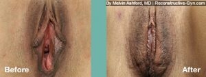 Labiaplasty and Vaginoplasty