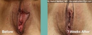 Labiaplasty and Vaginoplasty