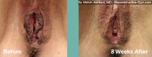 Labiaplasty and Rejuvenation