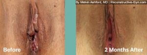 Labiaplasty, Vaginoplasty, and Clitoroplasty