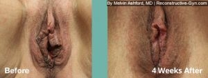 Labiaplasty and Vaginoplasty