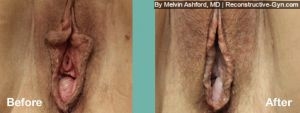 Vaginoplasty and Labiaplasty